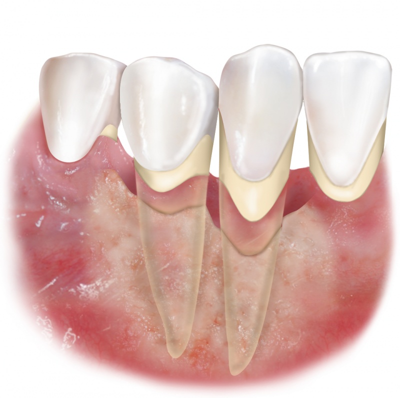 Протезирование зубов при пародонтозе в клинике Ас-Стом