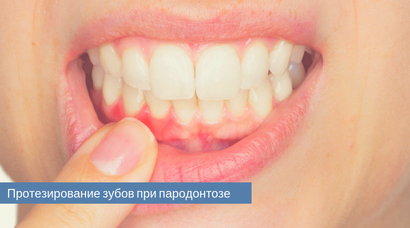 протезирование зубов при пародонтозе.png