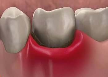 Зуб реагирует на холодное после пломбирования