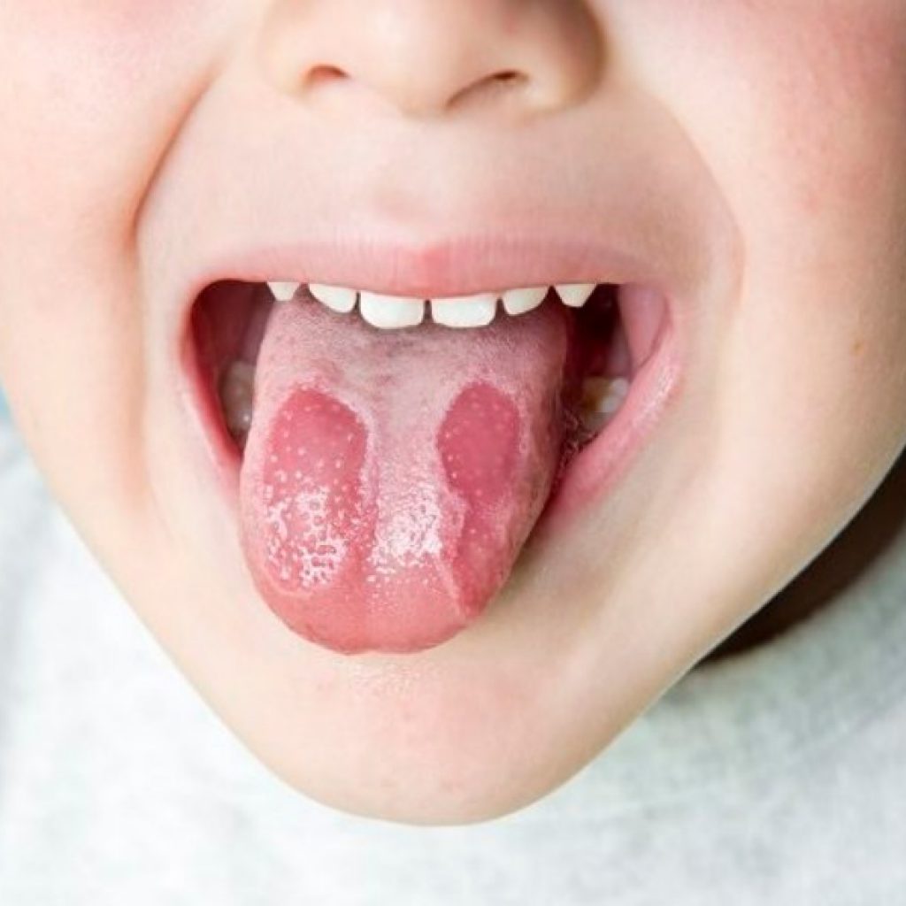 Стоматит у детей во рту заразен или нет thumbnail