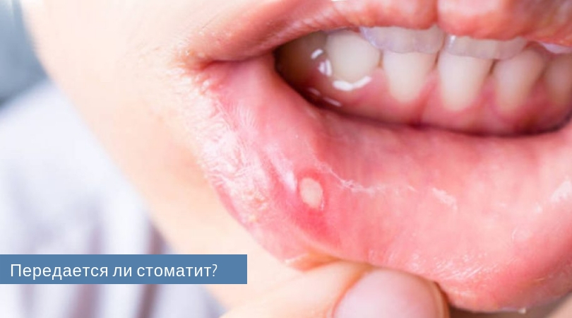 Стоматит у детей во рту как передается thumbnail